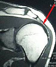 Kernspintomographie (MRI) der Schulter: intakte Sehne